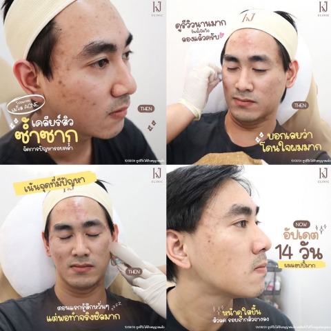 รักษาสิว อินทามระ